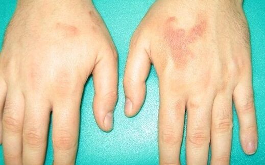 des douleurs dans les articulations des mains peuvent être des symptômes de parasites