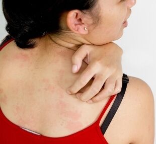 granulomes sur le corps - symptômes de la présence de parasites