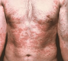 une peau problématique est un symptôme de la présence de parasites