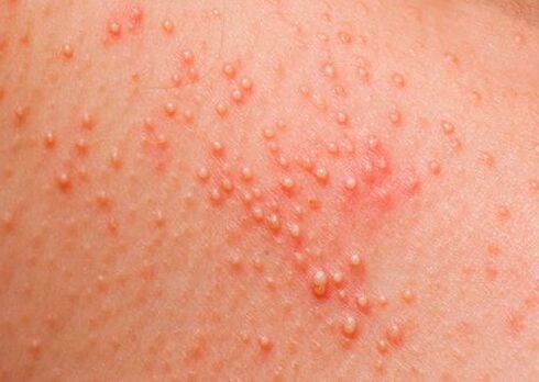Si le corps est affecté par des parasites, une allergie cutanée apparaît