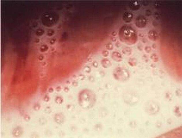 décharge de bulles avec des parasites protozoaires