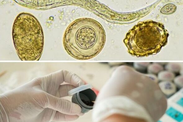 diagnostic de la présence de parasites dans le corps