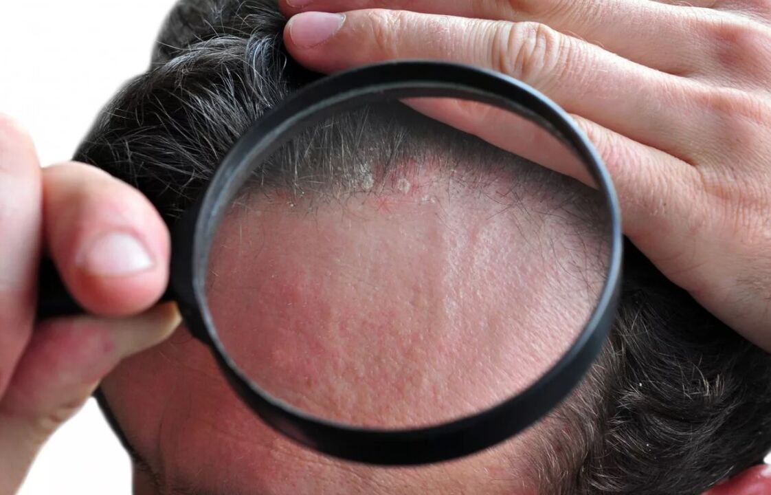 Cuir séborrhéique